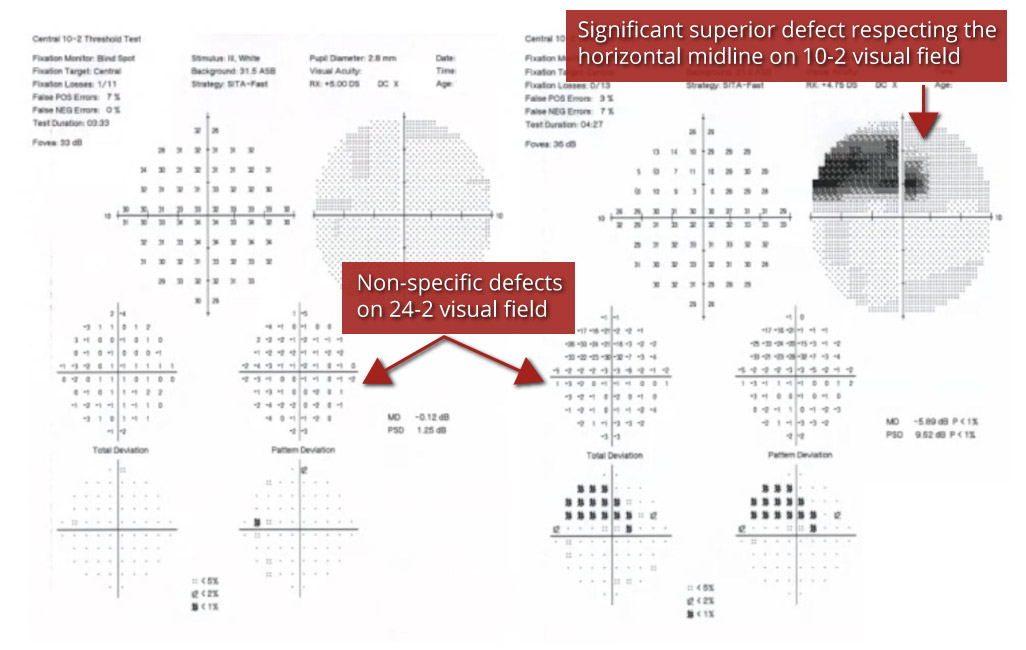 Glaucoma Coach #8 Analysis - Fig 4