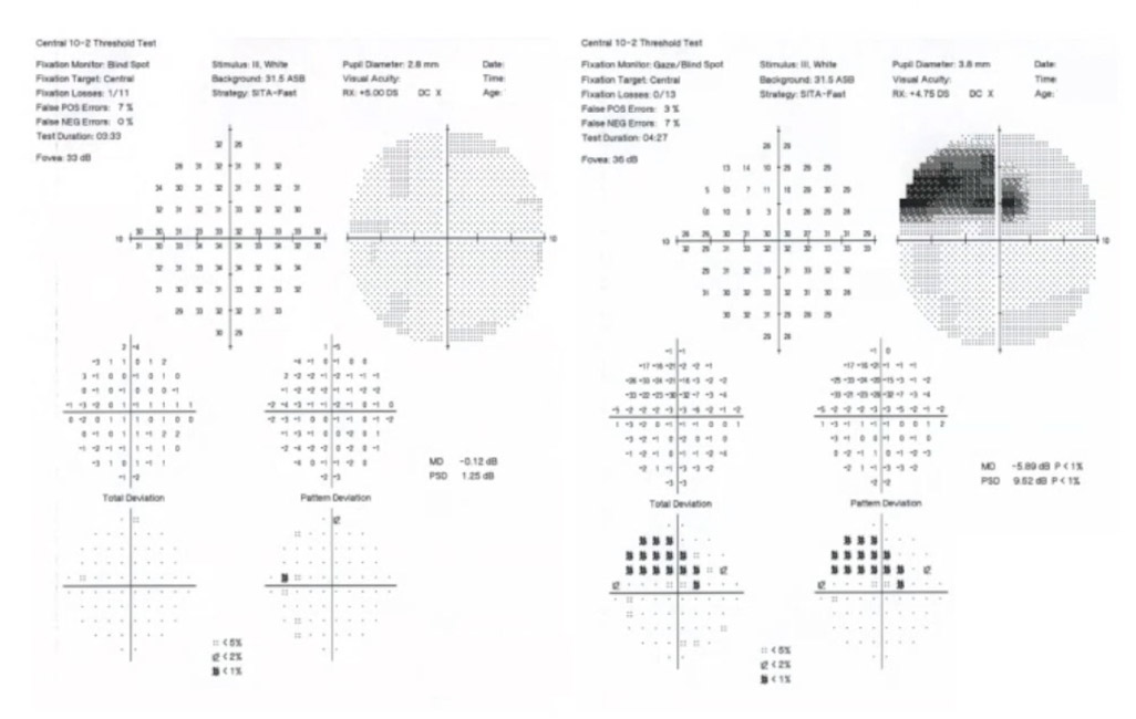 Glaucoma Coach #8 - Fig 2