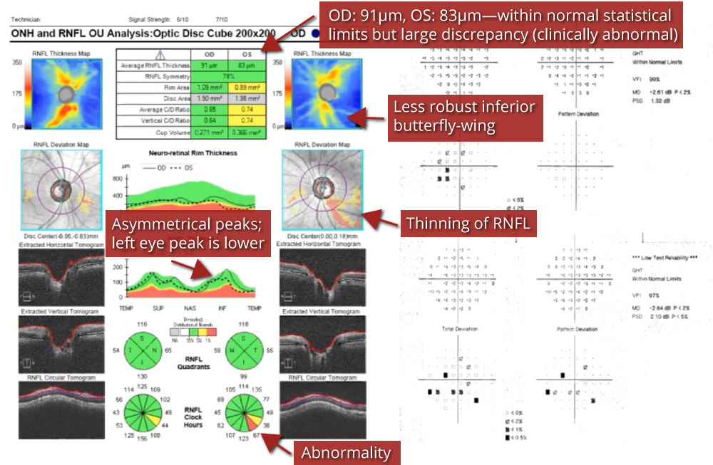 Glaucoma Coach #8 Analysis - Fig 3