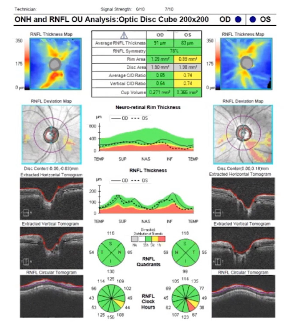 Glaucoma Coach #8 - Fig 1