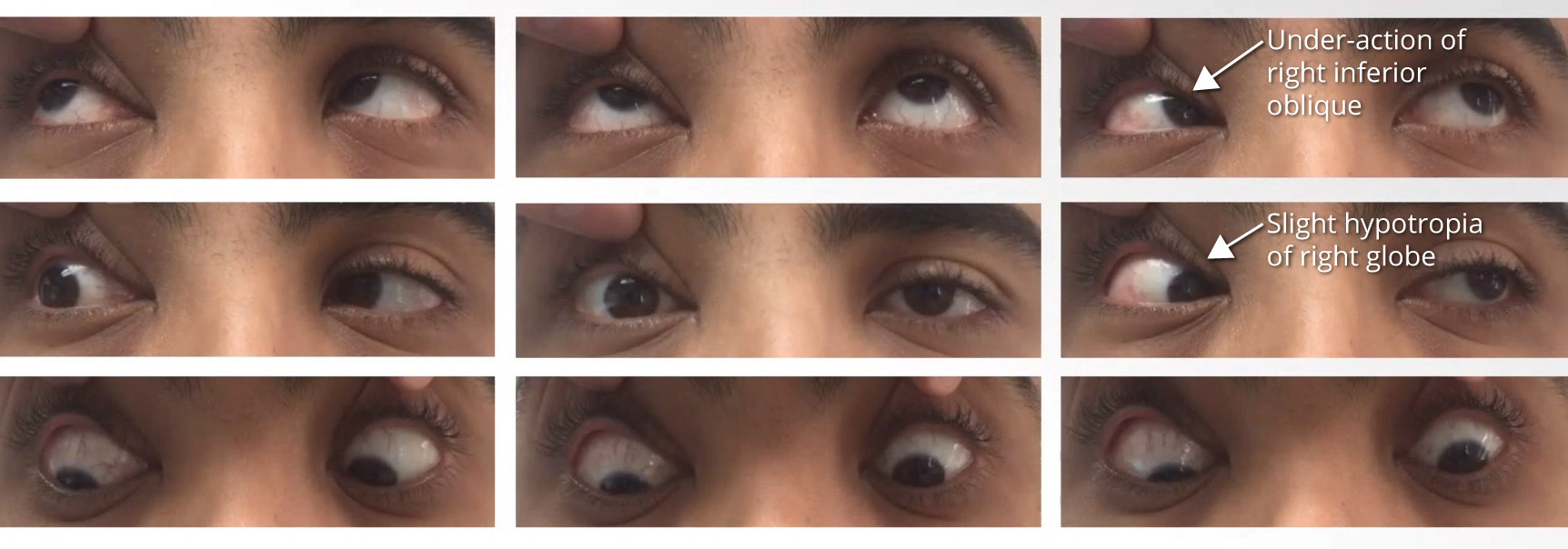 Right ptosis and slight hypotropia - OPTOCASE