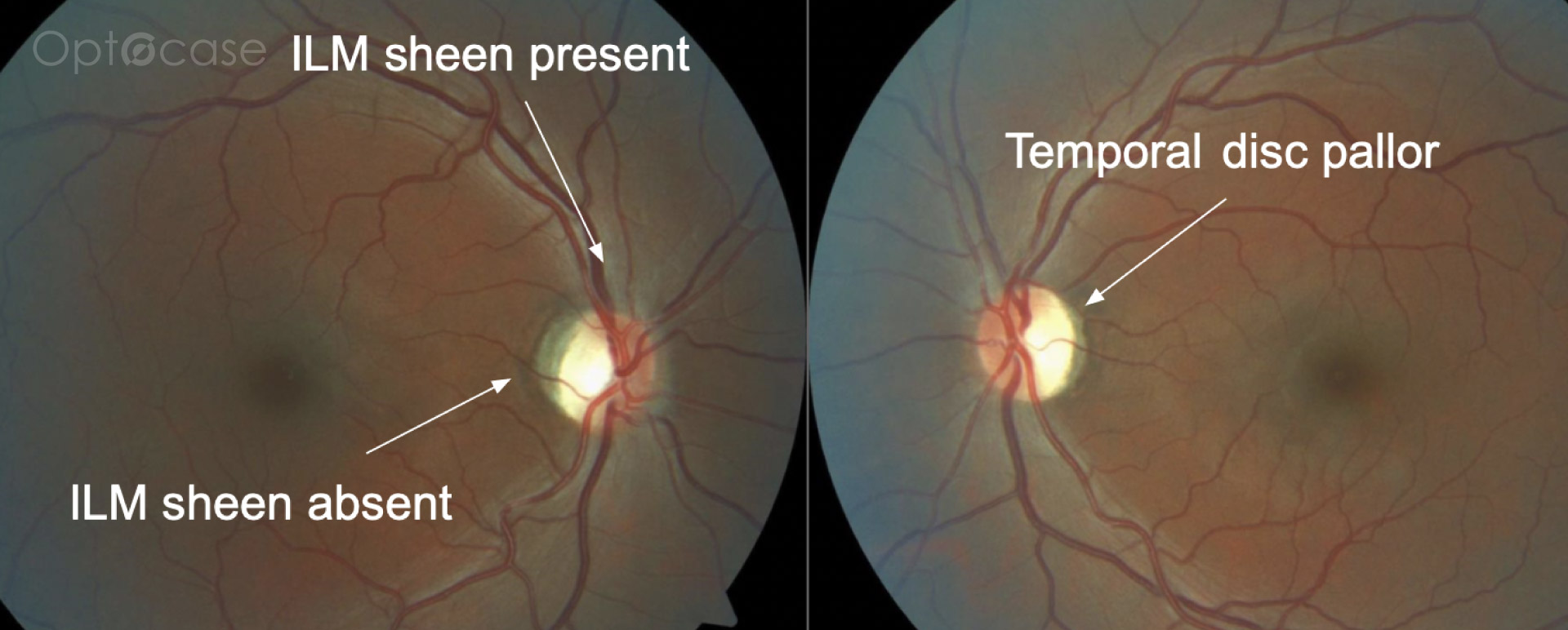Neuro Coach #017 Analysis