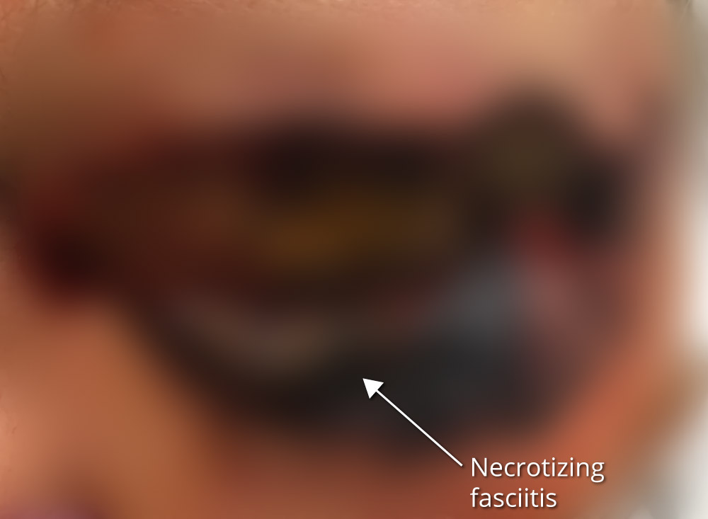 Plastics Coach #10 - Septicemia - Analysis - Blurred