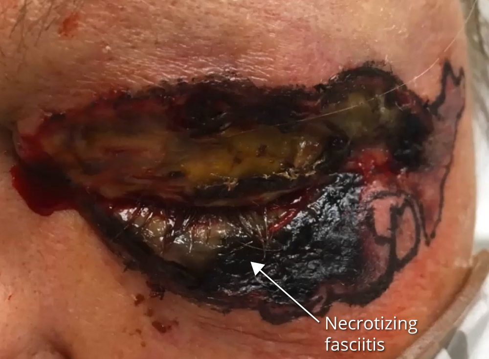 Plastics Coach #10 - Septicemia - Analysis - Blurred