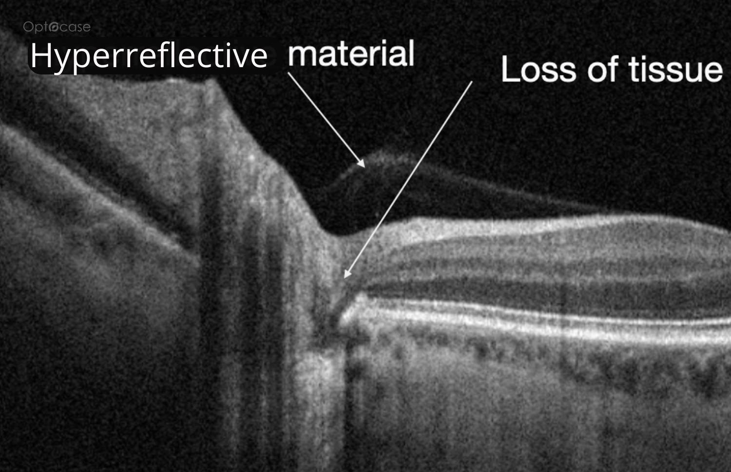 Optic Nerve Issue OPTOCASE