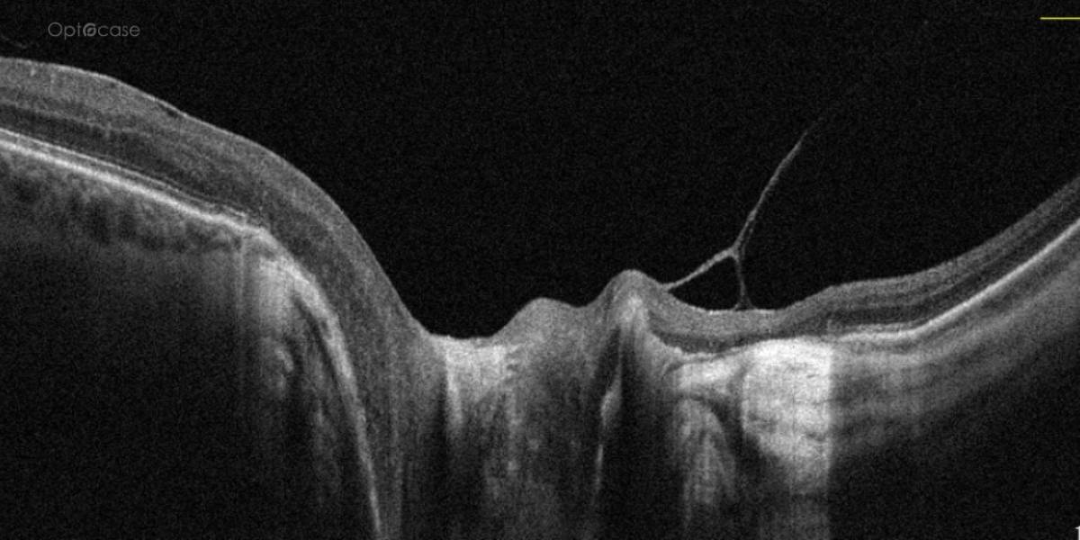 Disc Hyperreflectivity OPTOCASE