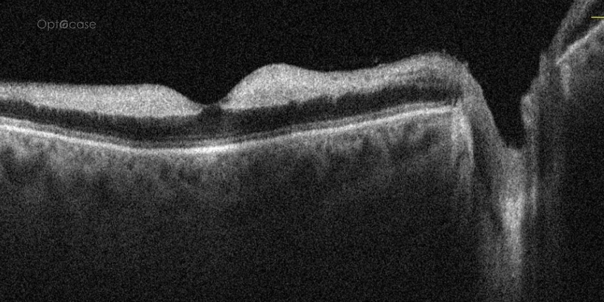 Thickened Inner Retina - OPTOCASE